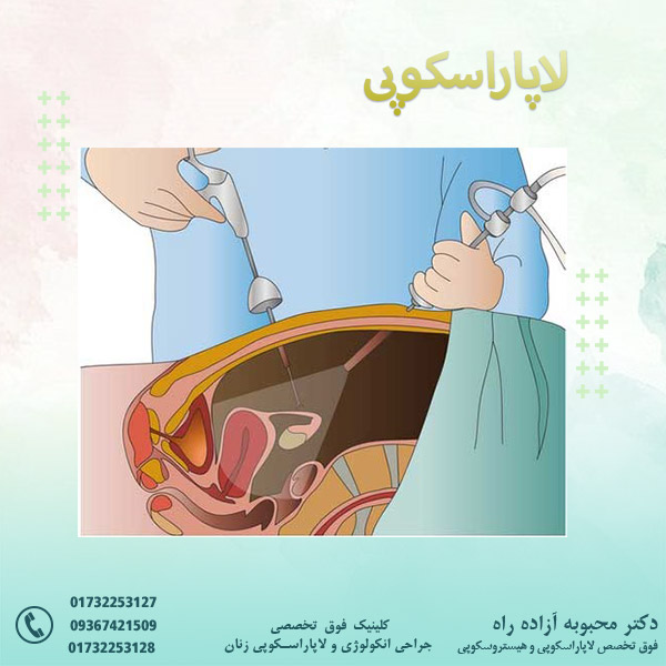 لاپاراسکوپی