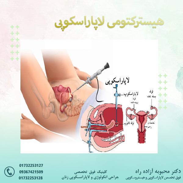 هیسترکتومی لاپاراسکوپی