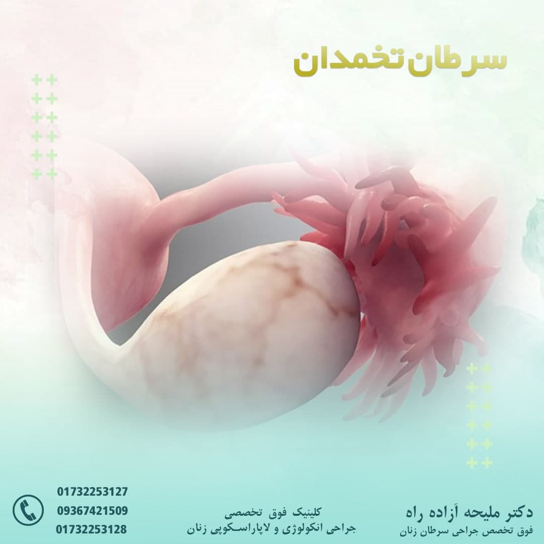 سرطان تخمدان