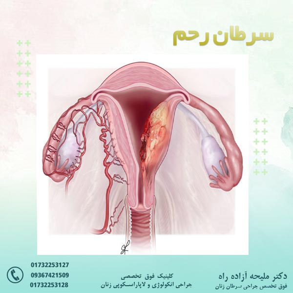 سرطان رحم