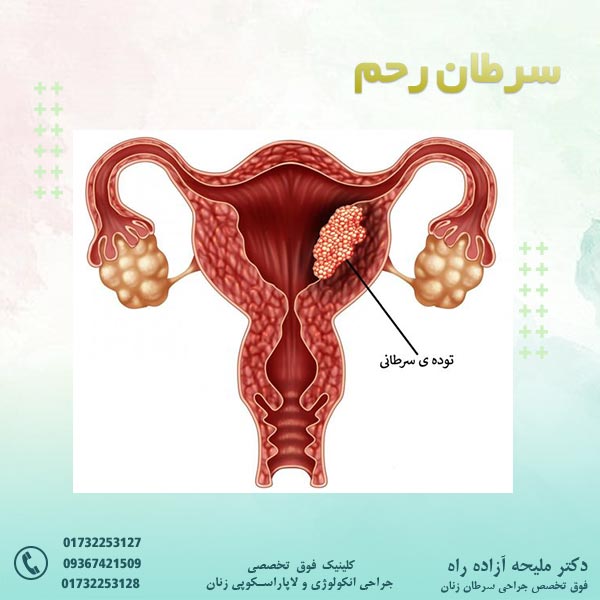 سرطان رحم - دکتر آزاده راه