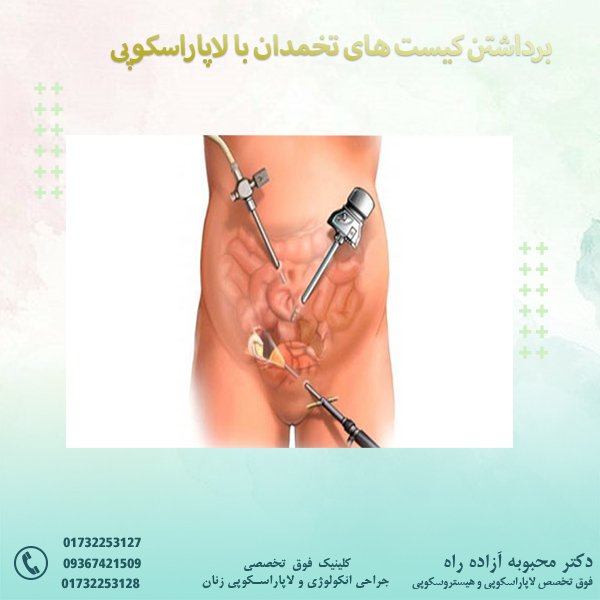 برداشتن کیست های تخمدان با لاپاراسکوپی