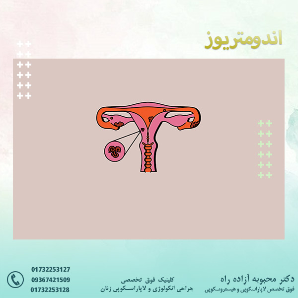 اندومتریوز - دکتر آزاده راه