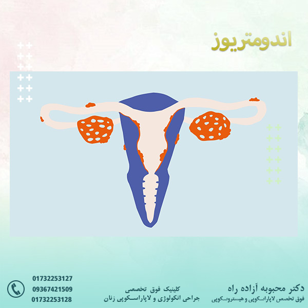 اندومتریوز - دکتر آزاده راه