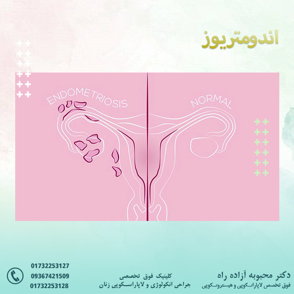 اندومتریوز