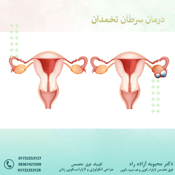 درمان سرطان تخمدان