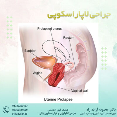 افتادگی رحم - دکتر آزاده راه