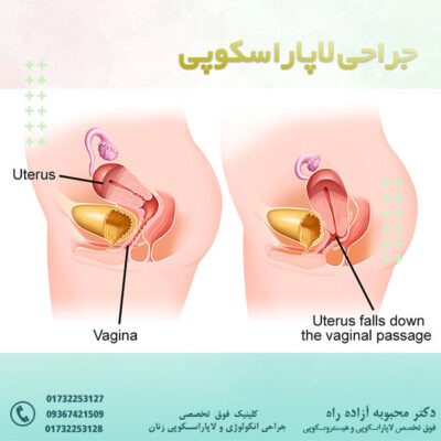 افتادگی رحم - دکتر آزاده راه