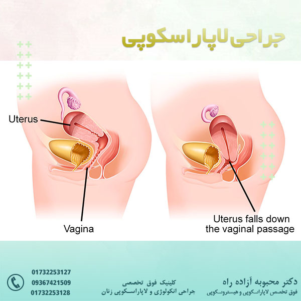 افتادگی رحم