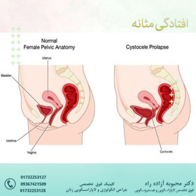 افتادگی مثانه - دکتر آزاده راه