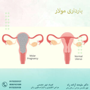 بارداری مولار