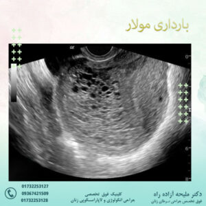 بارداری مولار