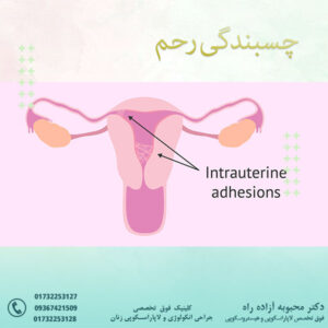 چسبندگی رحم - دکتر آزاده راه