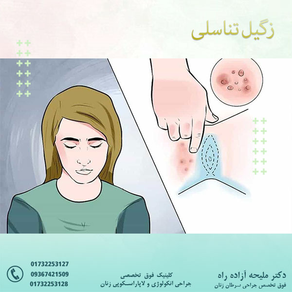 زگیل تناسلی