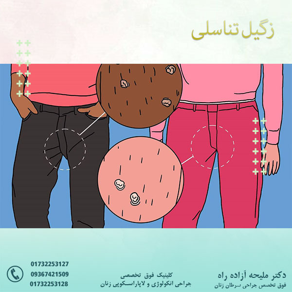زگیل تناسلی - دکتر آزاده راه