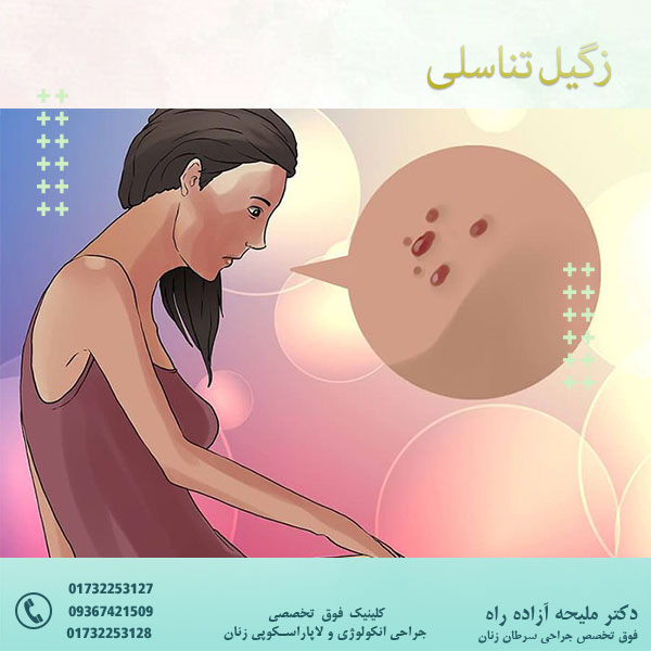 زگیل تناسلی - دکتر آزاده راه