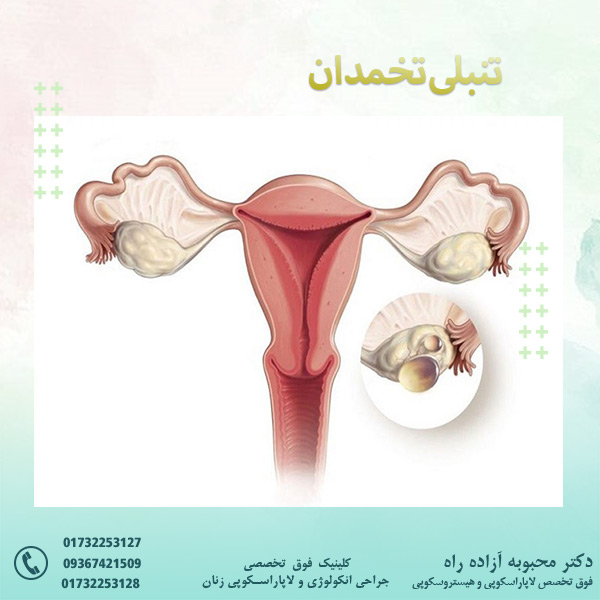 تنبلی تخمدان - دکتر آزاده راه
