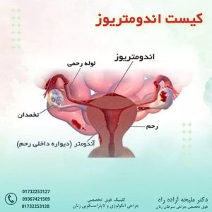 اندومتریوز