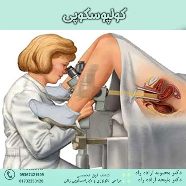 کولپوسکوپی