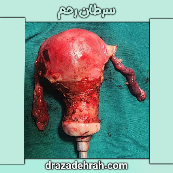 سرطان رحم ، کلینیک آزاده راه در گرگان