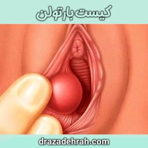 کیست بارتولن از دکتر آزاده راه ، بهترین جراح و متخصص زنان در گرگان