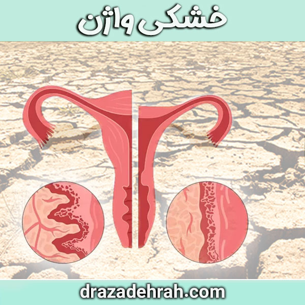 خشکی واژن کلینیک آزاده راه در گرگان
