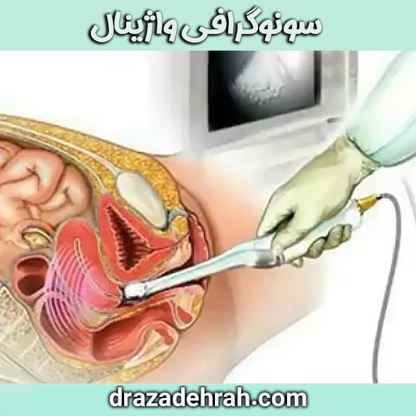 سونوگرافی واژینال از دکتر آزاده راه در گرگان