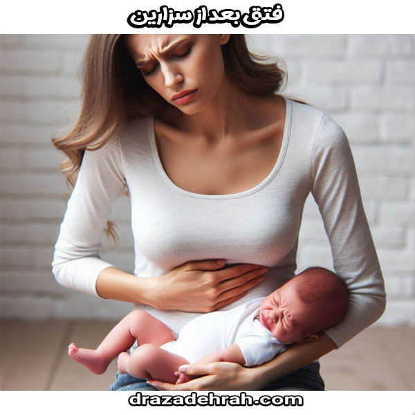فتق بعد از سزارین از کلینیک فوق تخصصی زنان در گرگان