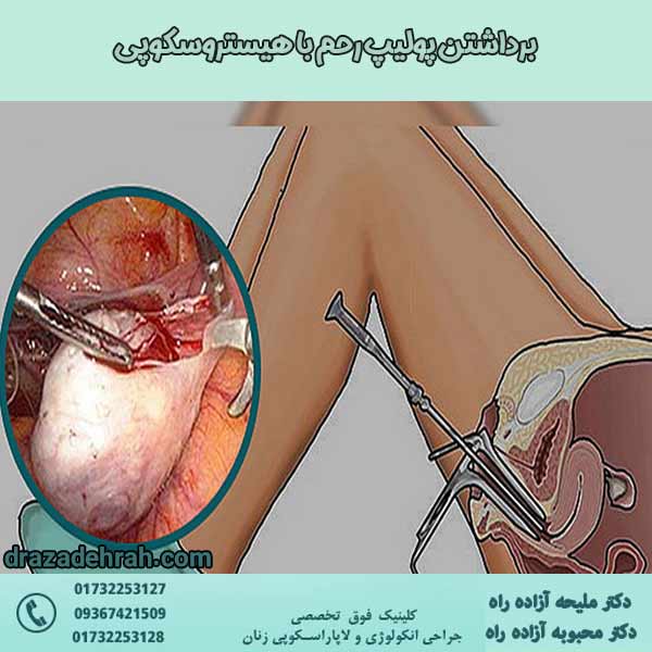 برداشتن پولیپ رحم با هیستروسکوپی - دکتر آزاده راه جراح زنان گرگان
